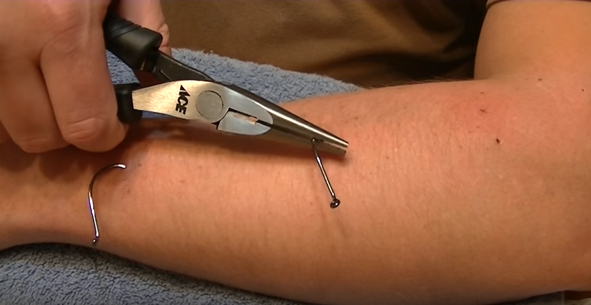 removing a fish hook stuck in hand