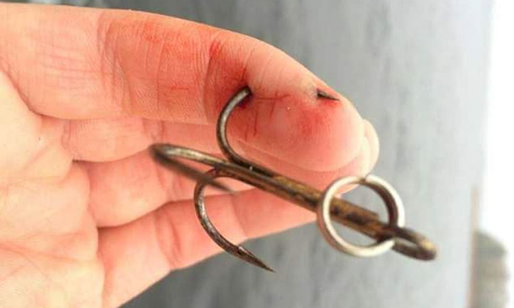 treble hook in the finger