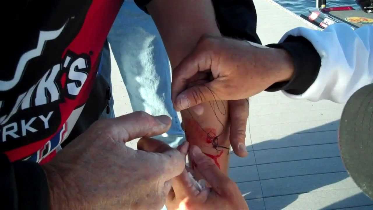 remove fish hook from skin