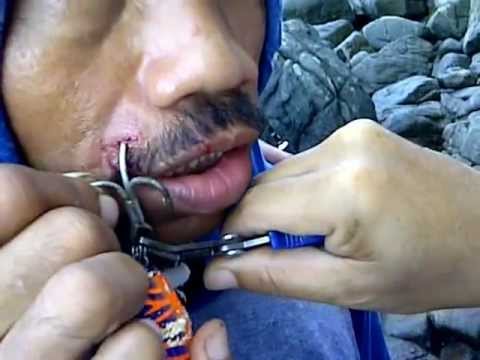 fishing hook in lip