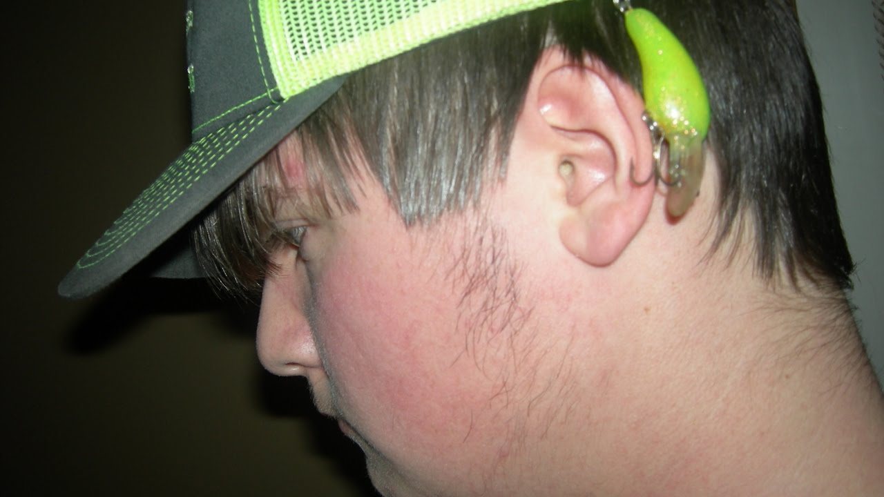 fishing hook stuck in head