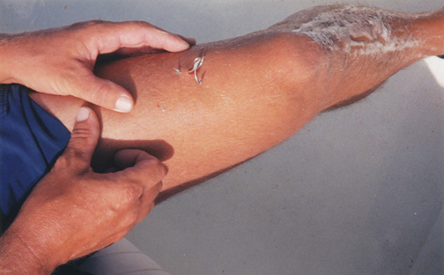 fish hook stuck in leg