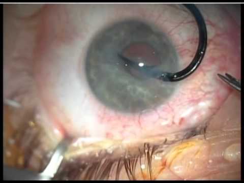 hook in the eye