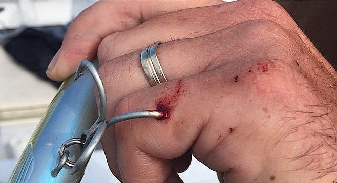 hook in pinky finger in the bone