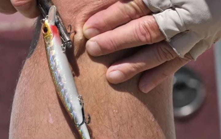 fish hook removal