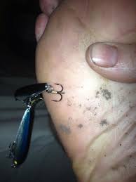 fishing hook in foot
