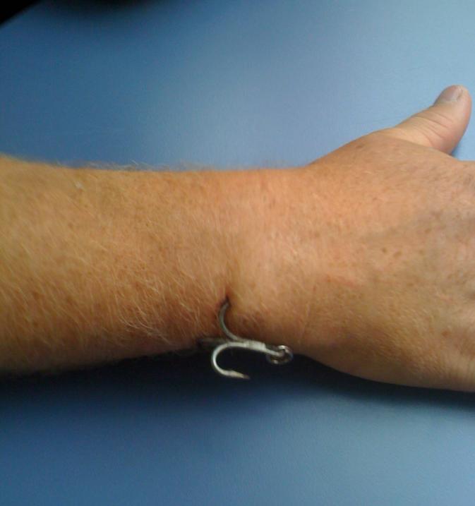 hook lodged in hand