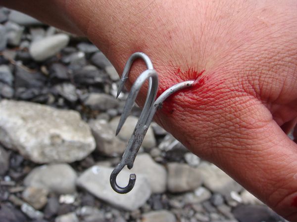 treble hook injury